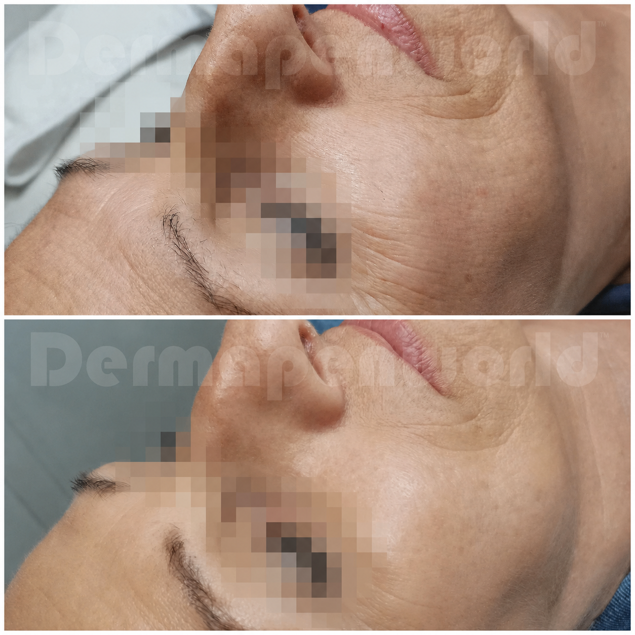 Före- och efterbild från DermapenWorld
